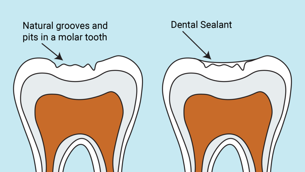 Different filling materials - Oral Health Foundation