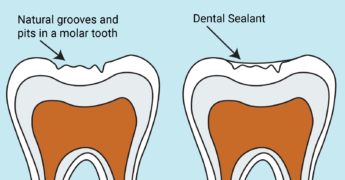 What Are Dental Sealants? - North Carolina Oral Health Collaborative