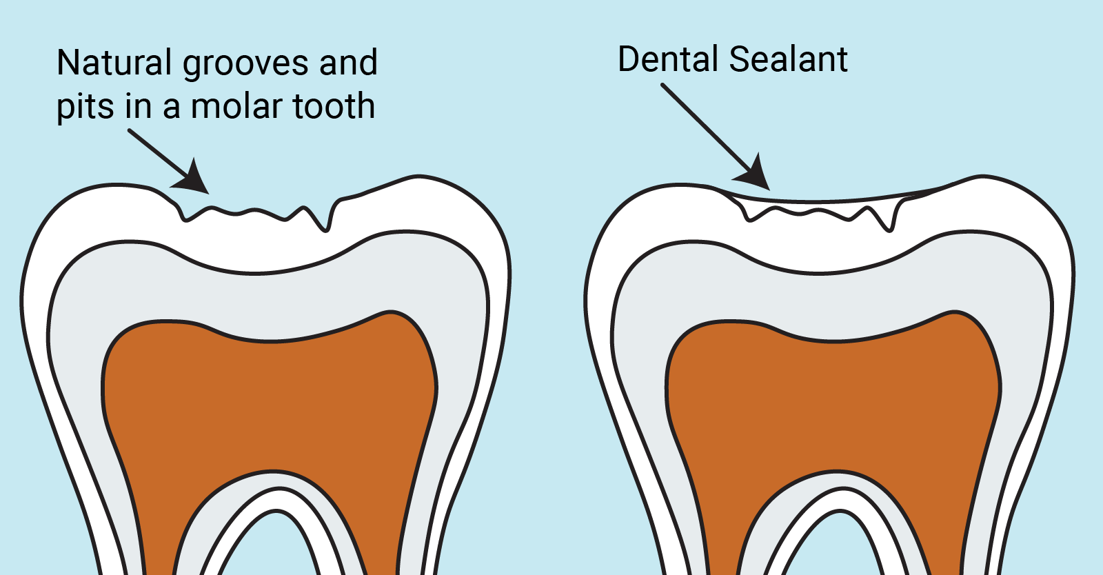 What Are Dental Sealants?